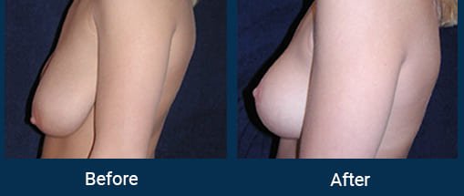 Breast Implant in Indore Bhopal, Breast Enlargement in Indore Bhopal, Breast Augmentation in Indore Bhopal, Breast Implant Surgery Cost in Indore Bhopal, Breast Implant Price in Indore Bhopal